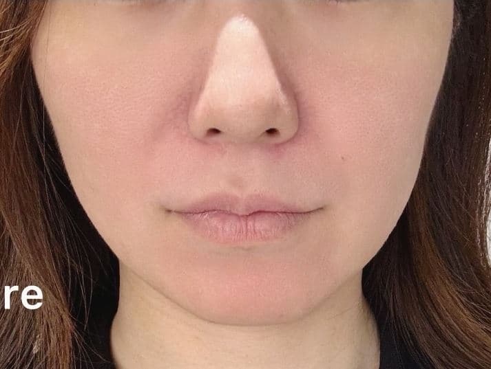 Custom Thread Lifting — Before