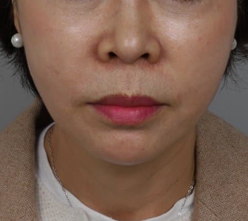 Custom Thread Lifting — After