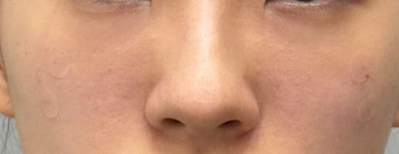 Eye Rejuvenation Filler — after