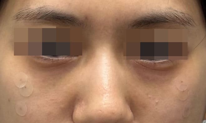 Eye Rejuvenation Filler — after