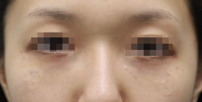 Eye Rejuvenation Filler — after
