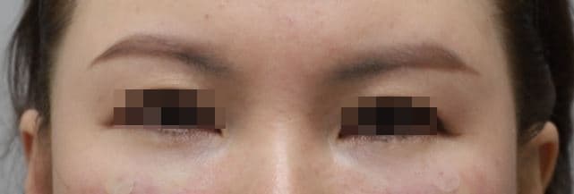 Eye Rejuvenation Filler — after