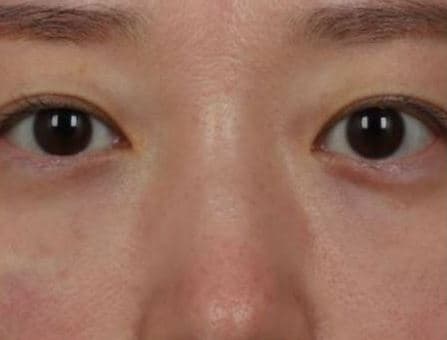 Eye Rejuvenation Filler — after
