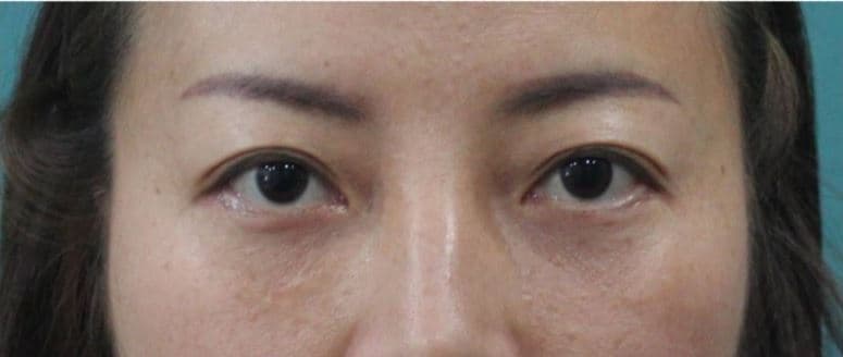 Eye Rejuvenation Filler — after