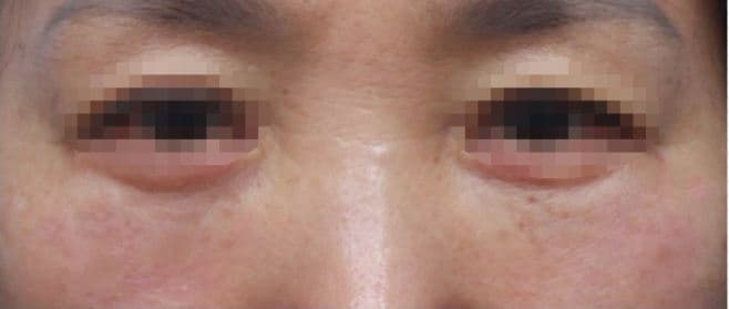 Eye Rejuvenation Filler — after