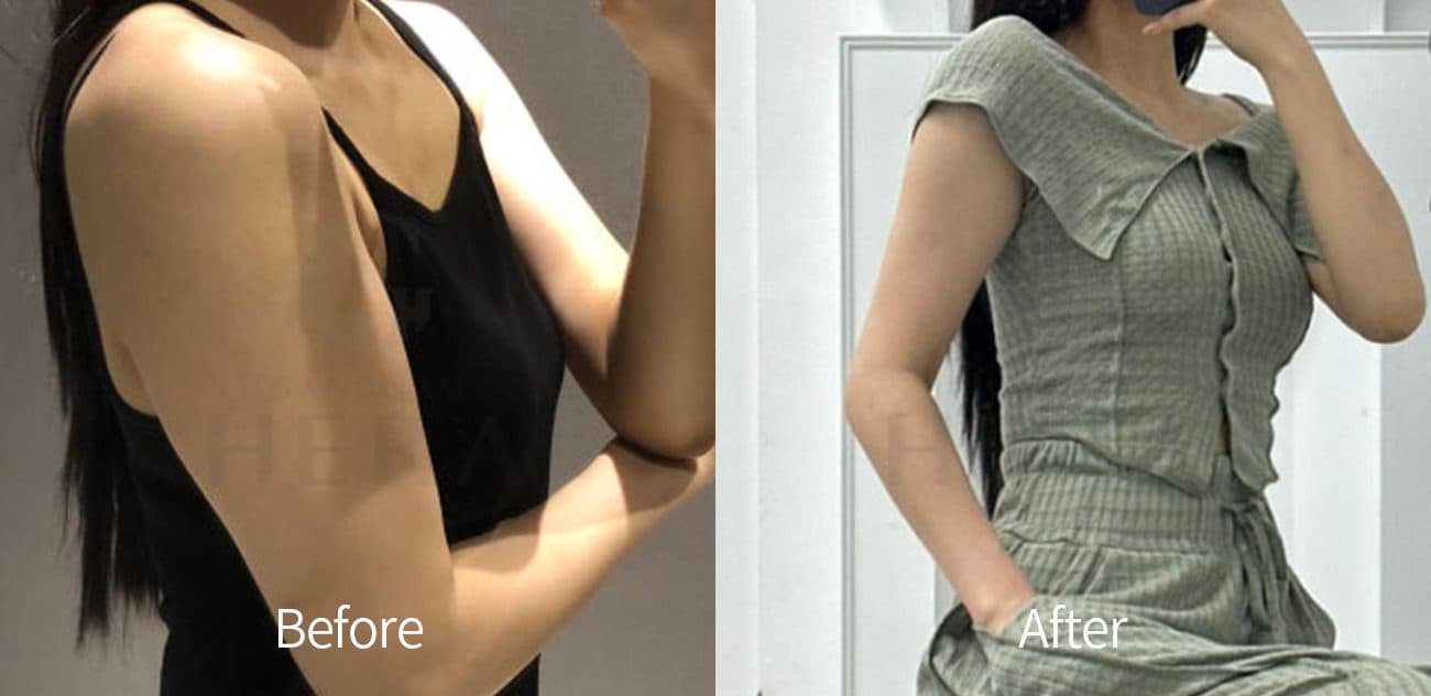 Sok-Sok Body Injection before and after