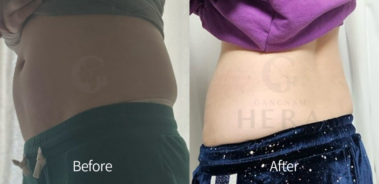 Sok-Sok Body Injection — after