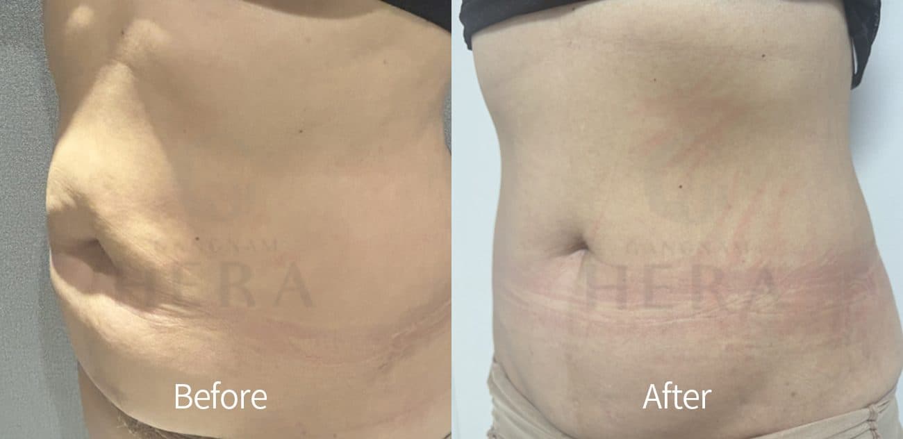Sok-Sok Body Injection before and after
