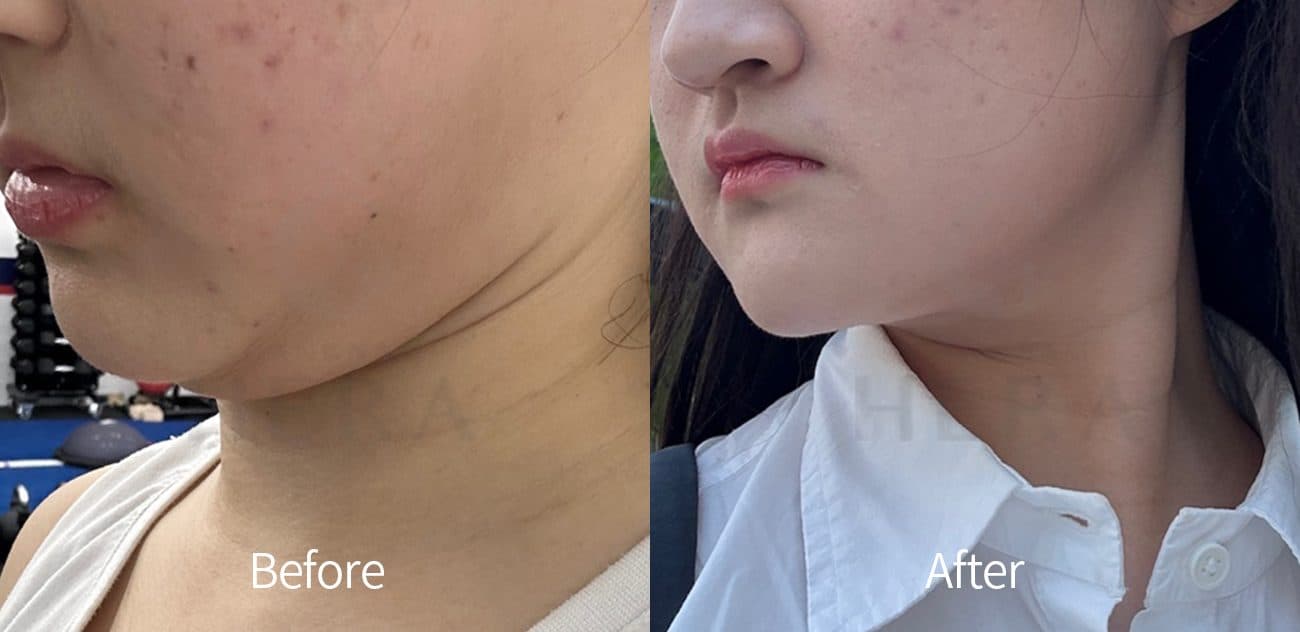 Sok-Sok Body Injection before and after