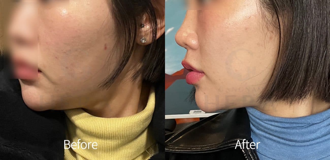 Sok-Sok Body Injection before and after