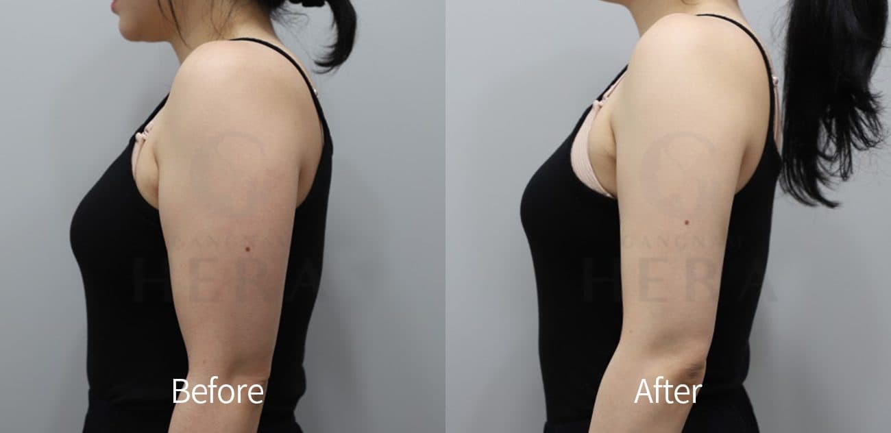 Sok-Sok Body Injection before and after