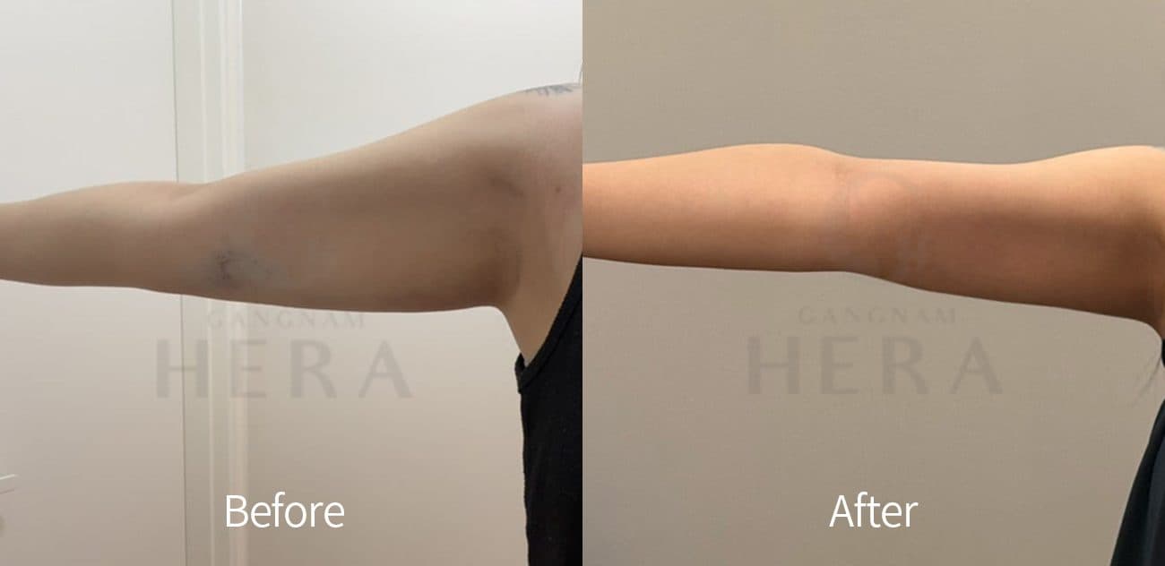 Sok-Sok Body Injection before and after