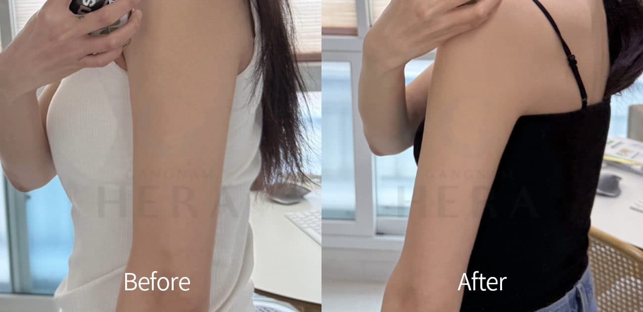 Sok-Sok Body Injection before and after