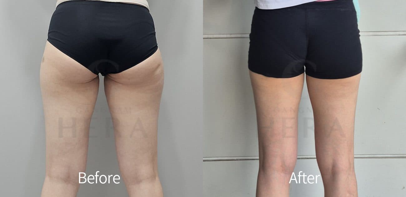 Sok-Sok Body Injection before and after