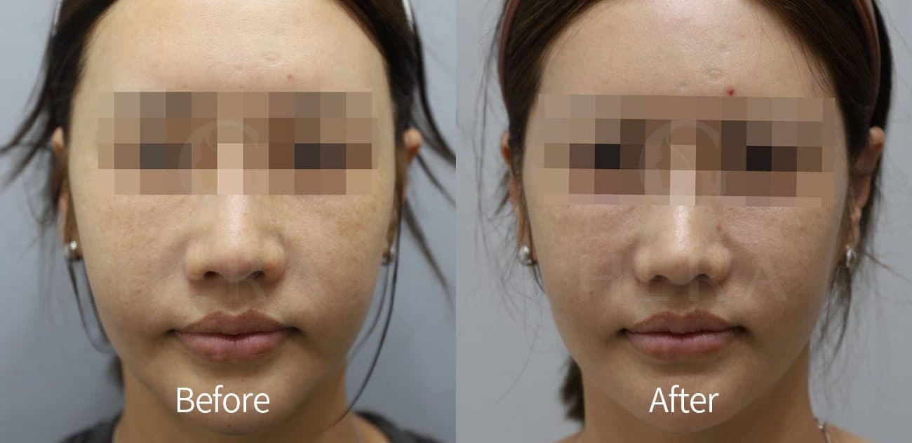 Sok-Sok Body Injection before and after