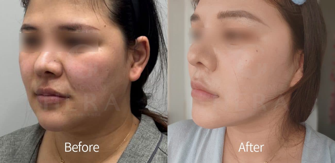 Sok-Sok Body Injection before and after