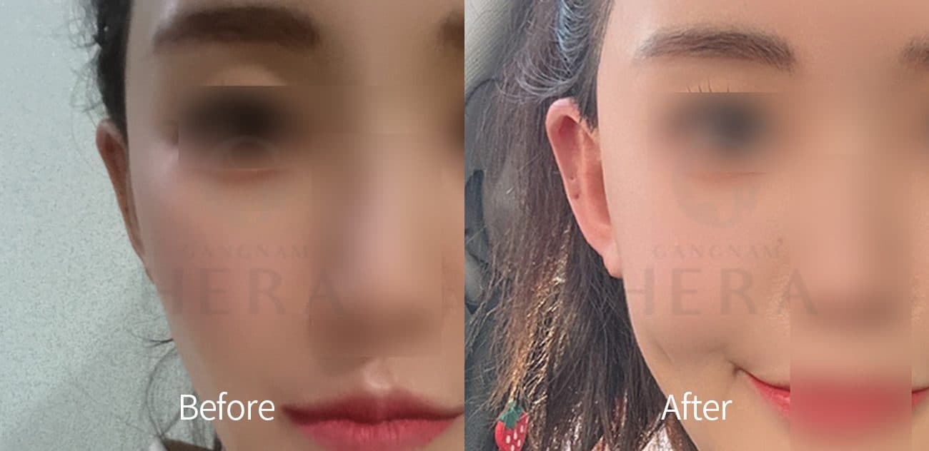 General Facial Fillers before and after