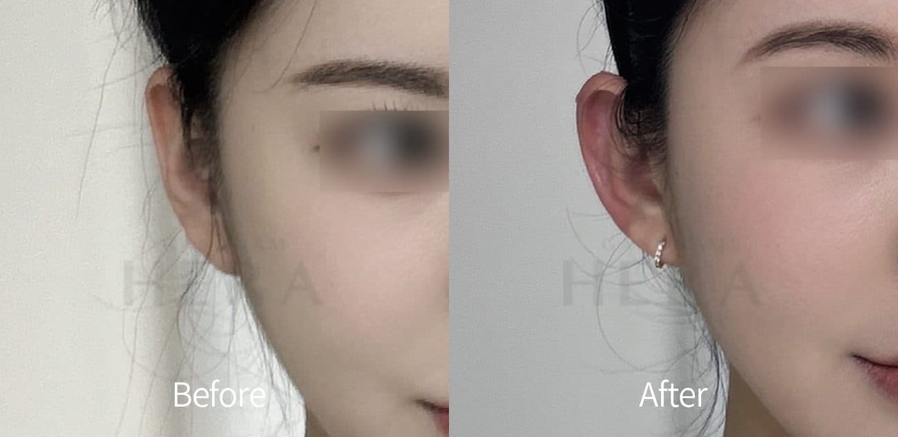 General Facial Fillers before and after