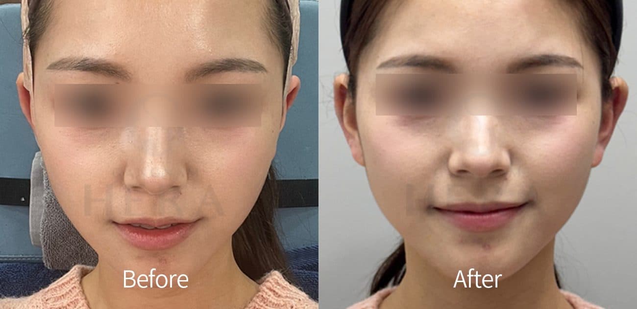 General Facial Fillers before and after
