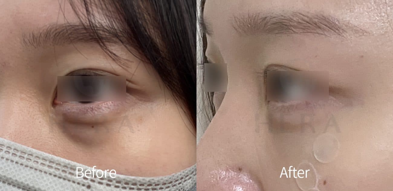 General Facial Fillers before and after
