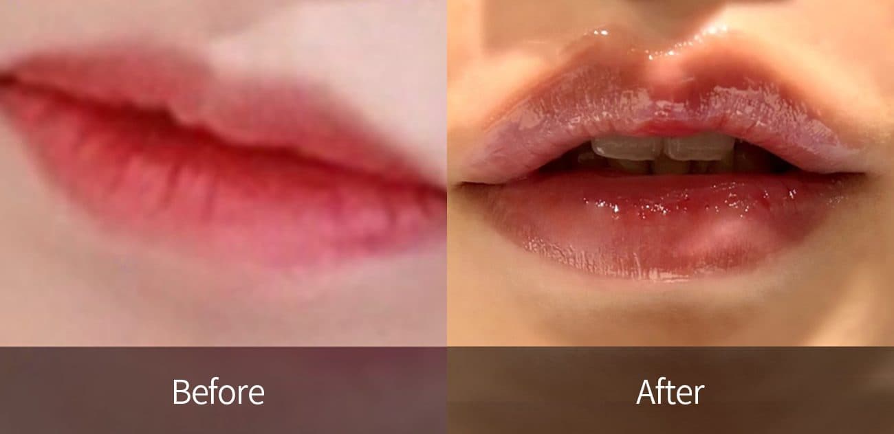 General Facial Fillers before and after