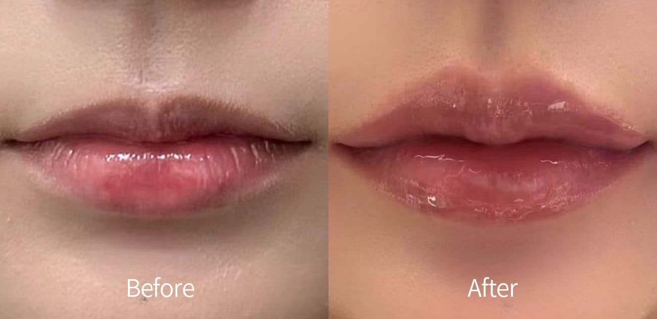 General Facial Fillers before and after