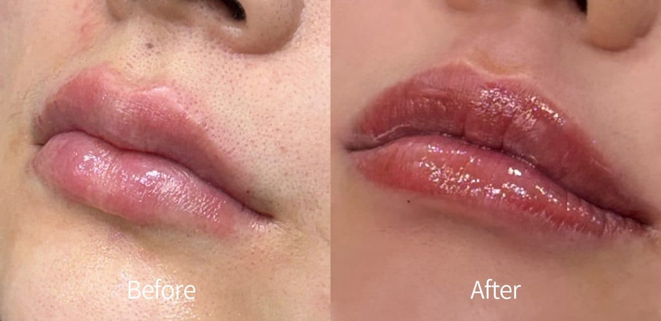 General Facial Fillers before and after