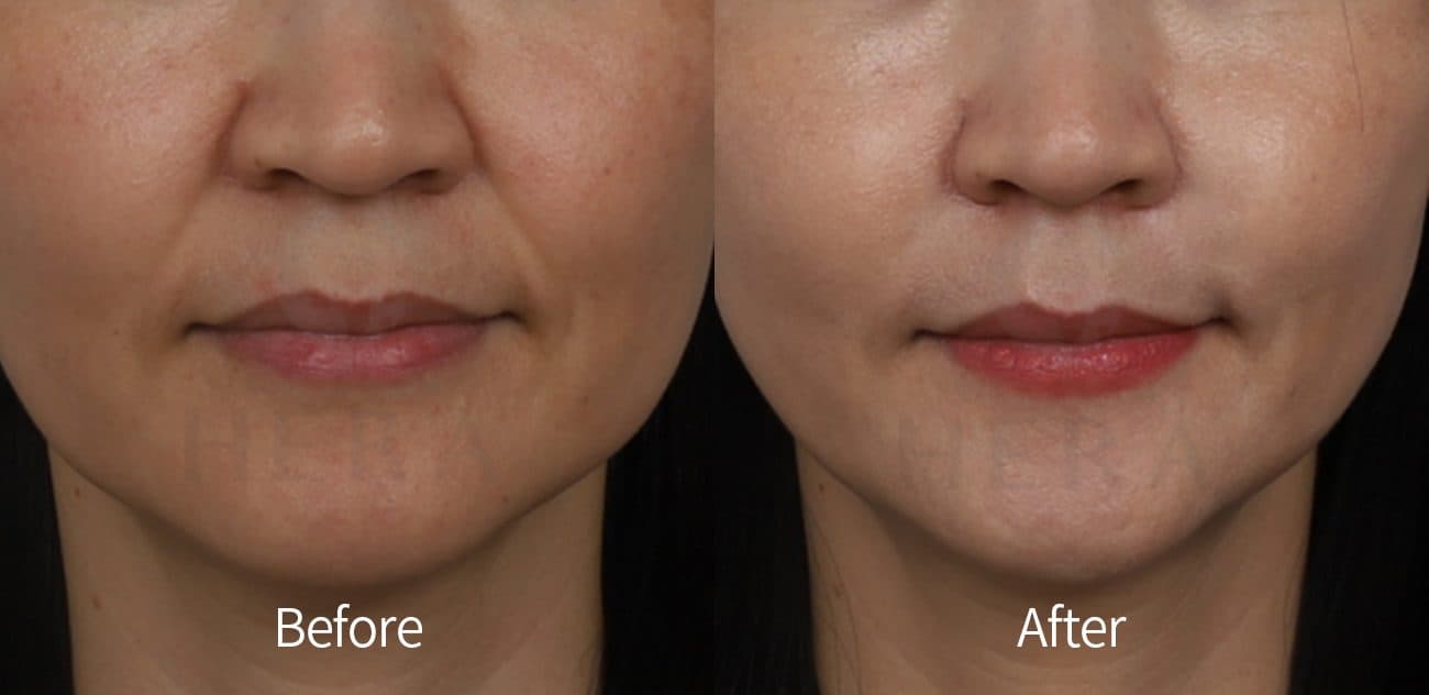 General Facial Fillers before and after
