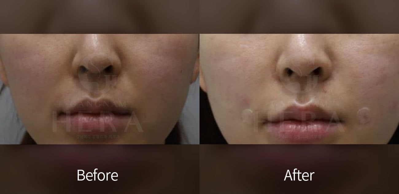 General Facial Fillers before and after