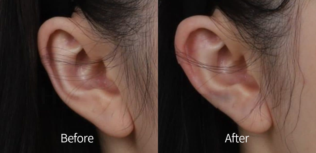 Ear Filler before and after
