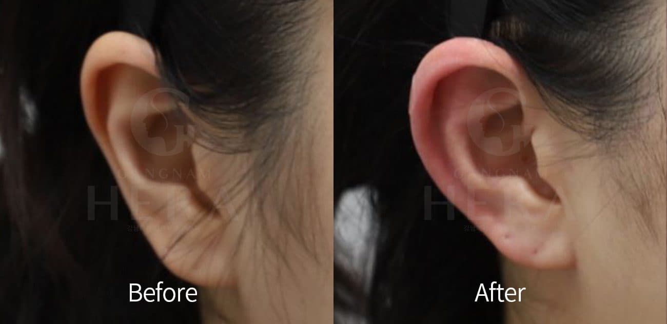 Ear Filler before and after