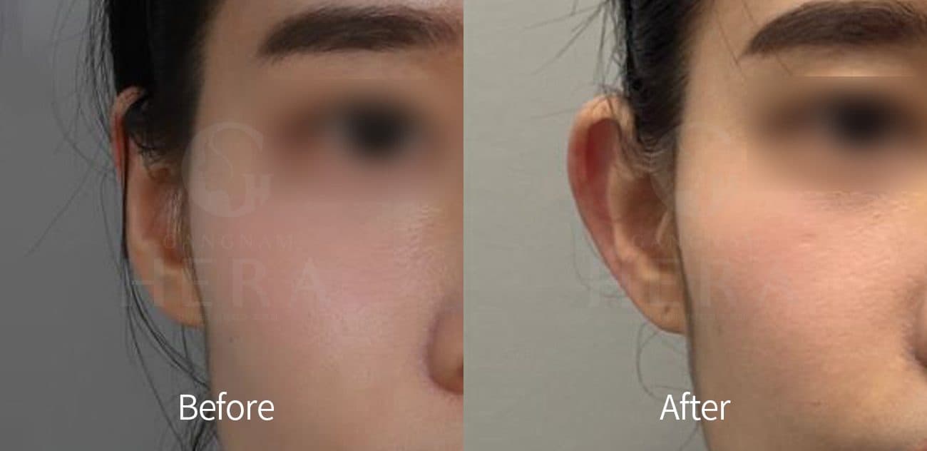 Ear Filler before and after