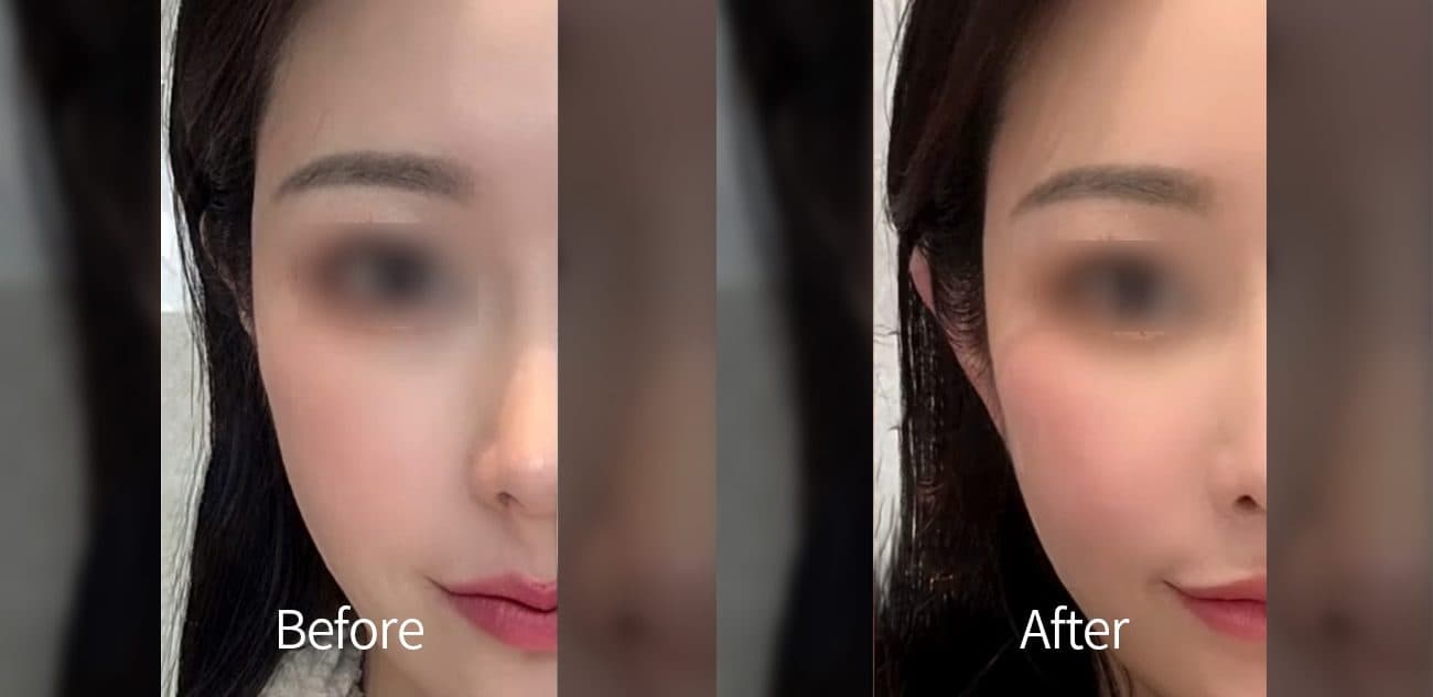 Ear Filler before and after