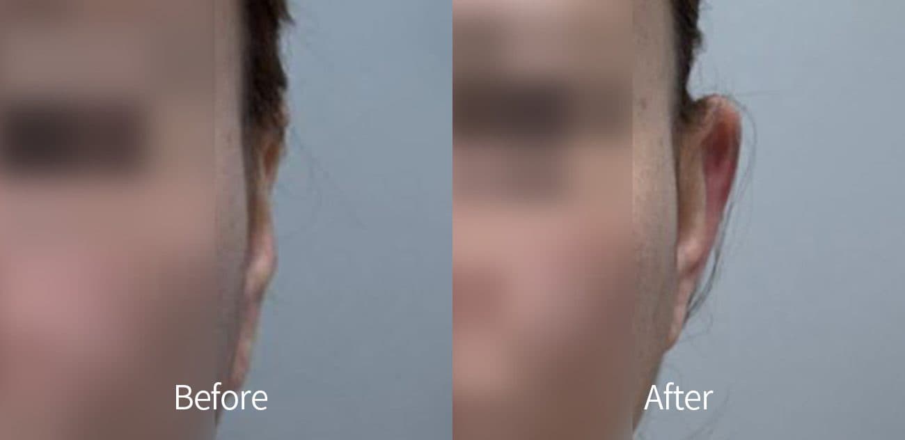 Ear Filler before and after