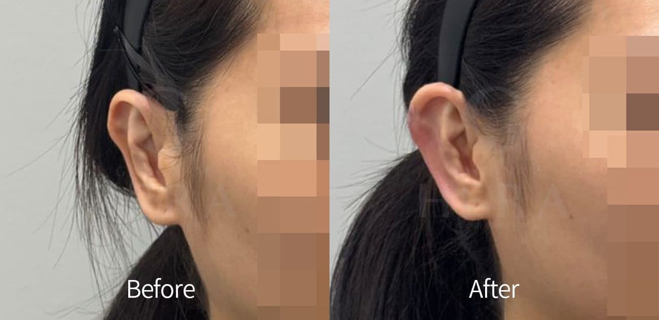 Ear Filler before and after