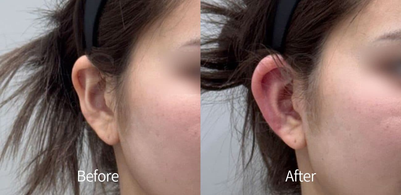 Ear Filler before and after