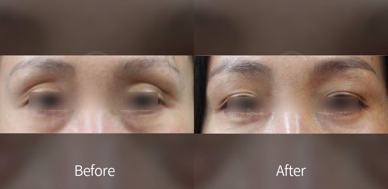 Eye Rejuvenation Filler before and after