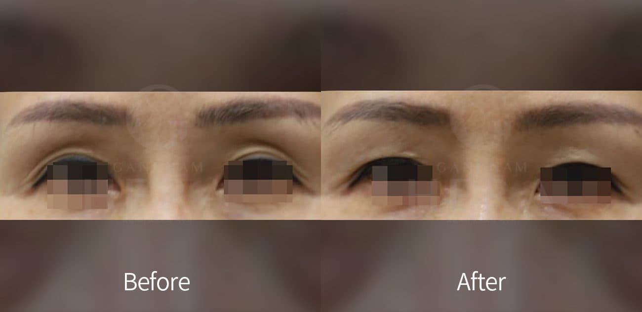 Eye Rejuvenation Filler before and after