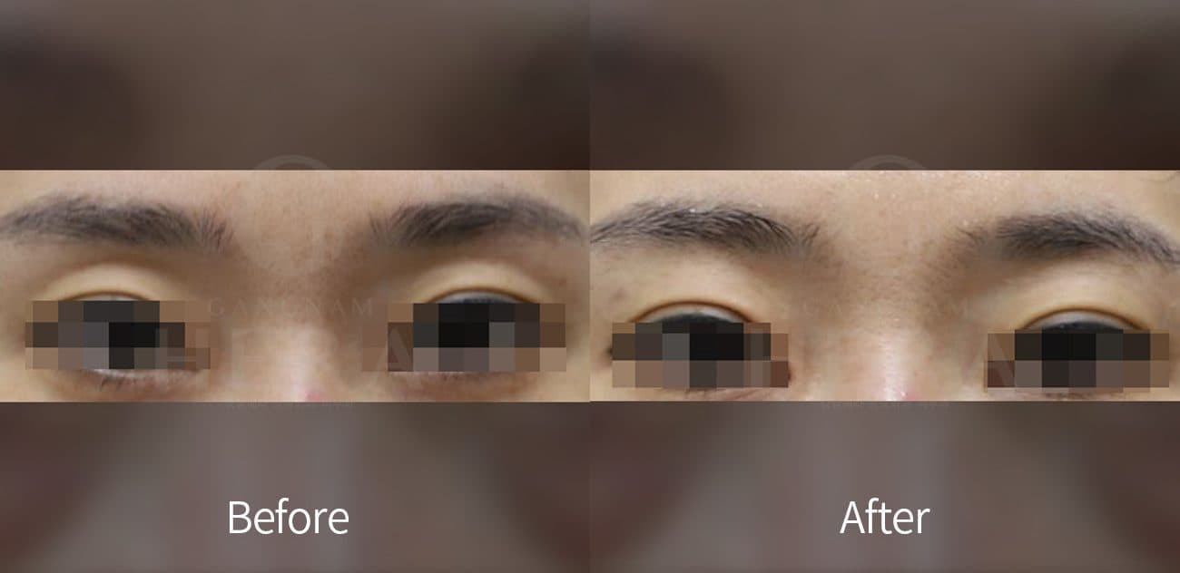 Eye Rejuvenation Filler before and after