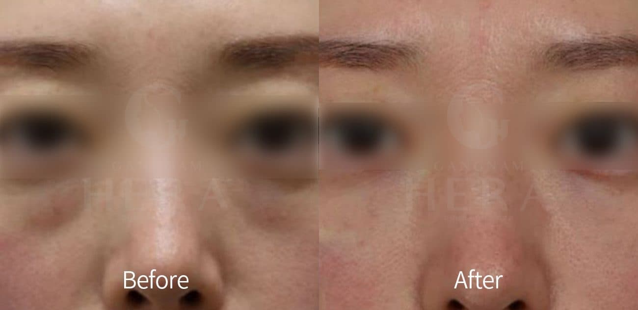Eye Rejuvenation Filler before and after