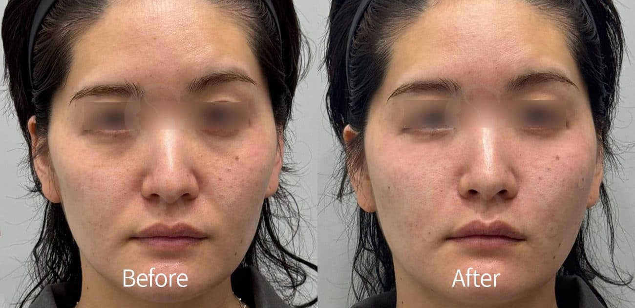 Eye Rejuvenation Filler before and after