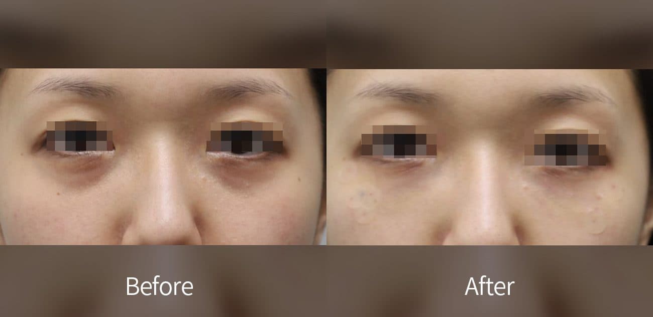 Eye Rejuvenation Filler before and after