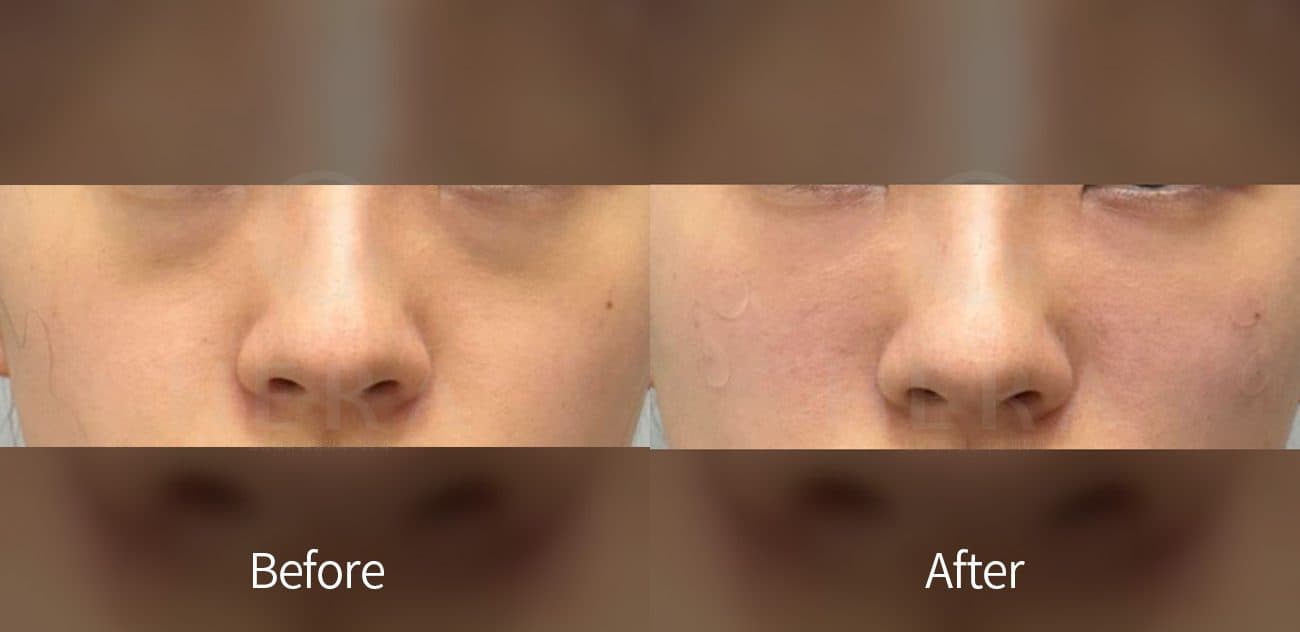 Eye Rejuvenation Filler before and after