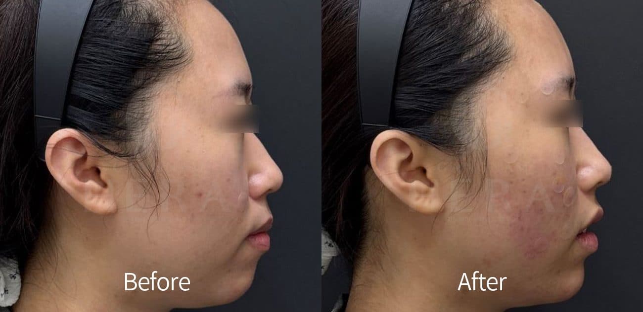 General Facial Fillers before and after