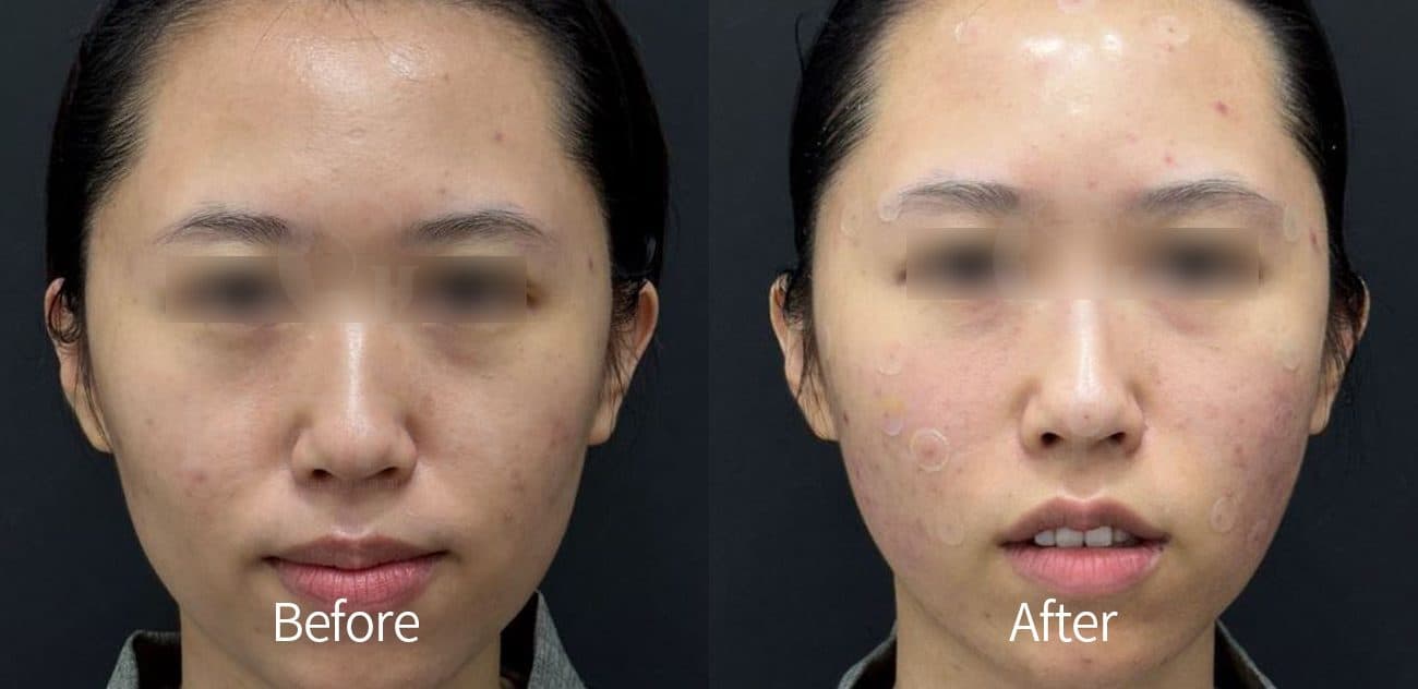General Facial Fillers before and after