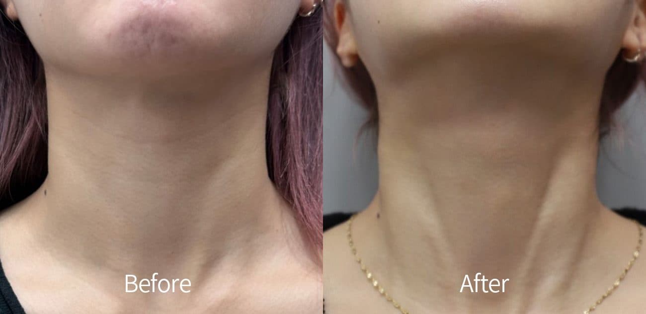 Neck Line Filler — after