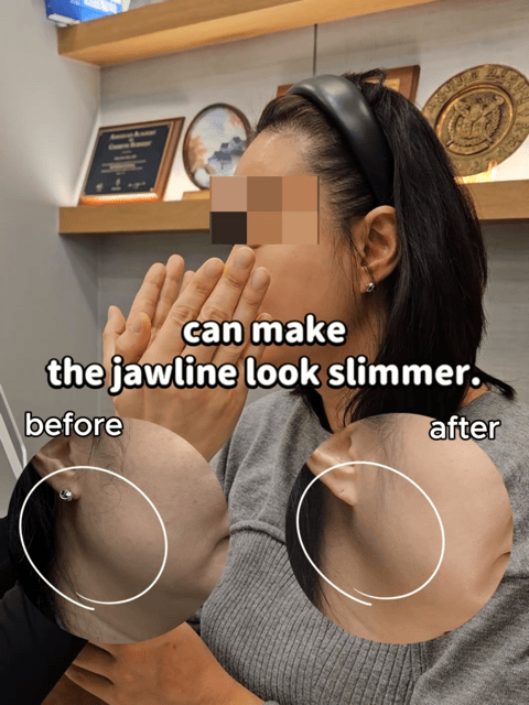 As we enter our 40s, many people start to notice: βοΈ Looser facial contours βοΈ A double chin βοΈ Deeper neck lines Improvement isnβt only about βlifting.β By reducing excess volume, refining the contours, and adding volume only where needed, the overall appearance can change significantly. This case combines: Ultherapy, fat-dissolving injections, Botox, and filler. Not to look unnaturally younger, but to look natural, clean, and refined. We offer facial contouring tailored for your 40s, with a balanced and thoughtful approach. For inquiries and appointments, please contact us via DM or WhatsApp.