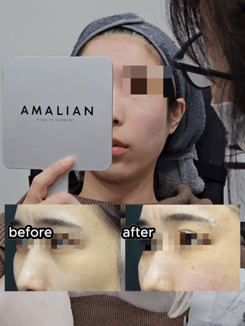 Even without lifting, your look can change this much. By adding only the necessary amount of filler to the temples, lateral cheeks, and chin, and combining chin Botox with Juvelook Eye, we refined the overall balance. Not to look unnaturally younger, but natural and smooth. This is a case that shows how much of a difference filler alone can make. π© For consultations and appointments, please contact us via DM or WhatsApp. * Results may vary by individual.
