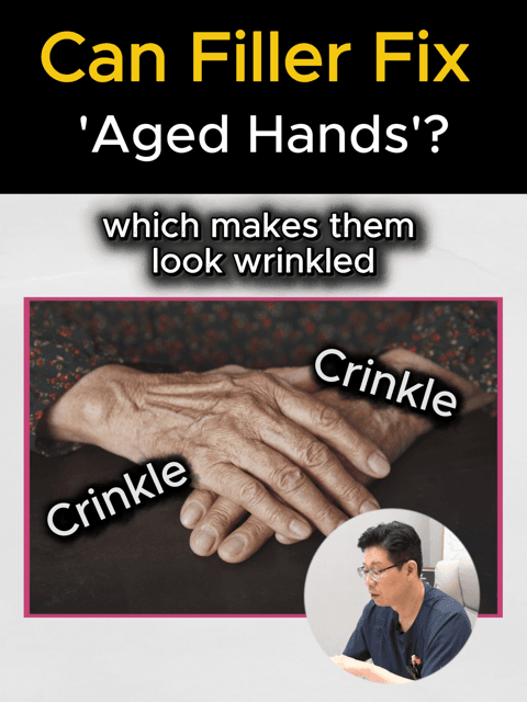 Restore Your Youth: The Magic of Hand Fillers ✨✋ Do you find yourself hiding your hands because of visible veins, tendons, or wrinkled skin? As we age, we lose volume in our hands, making them look older than we feel. But you don't have to let your hands give away your age! At Gangnam Hera, we provide a professional solution to restore that smooth, youthful look: ✅ Volume Restoration : Fills in hollow areas where fat has been lost. ✅ Vein & Tendon Camouflage : Softens the appearance of protruding vessels for a softer look. ✅ Smooth Texture : Deeply plumps the skin to reduce the "wrinkled" appearance. Experience an instant rejuvenation with natural-looking results. Let your hands match your youthful glow! 💎