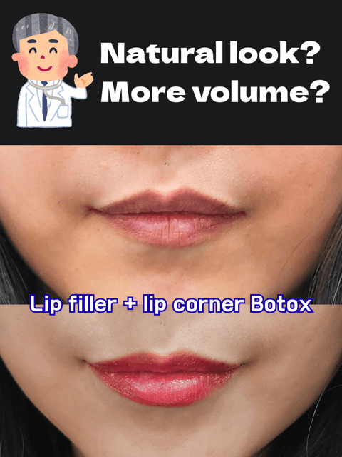 β¨ Natural Lip Filler in Seoul (Gangnam) β¨ Subtle, balanced, and beautifully tailored to your facial features. At Gangnam HERA Clinic, our lip filler treatments focus on: π Soft volume (not overdone) π Better lip symmetry π A more youthful, refreshed look π Doctor-performed, precision-based results If youβre visiting Korea and looking for a trusted clinic in Gangnam, Seoul, we provide full English support for international patients. πLocated in Gangnam, Seoul π© DM us to book your consultation